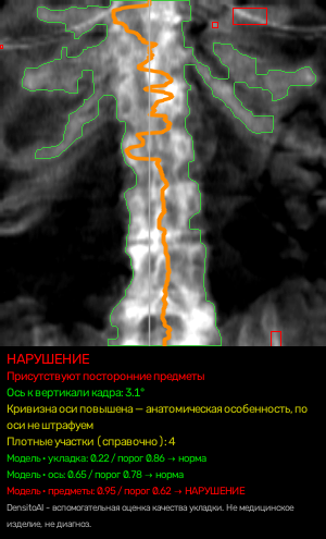 Визуализация сервиса: снимок поясничного отдела с найденной осью, контуром кости и плотными посторонними объектами